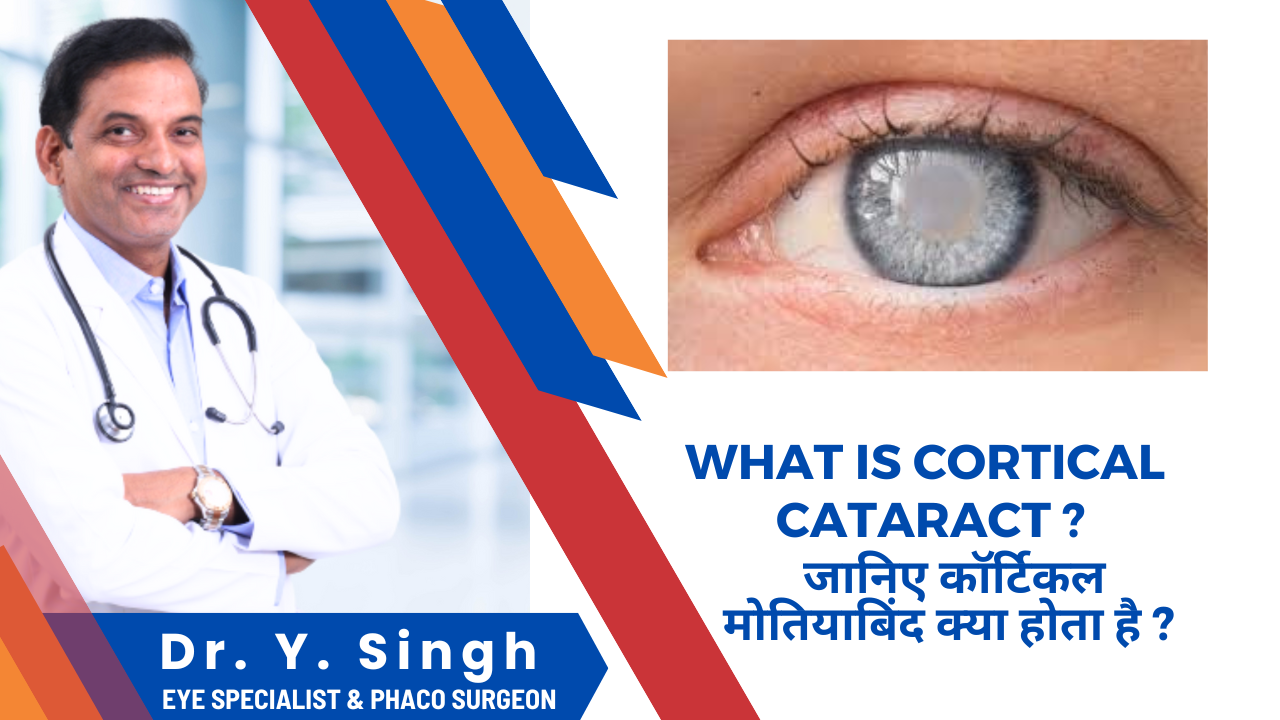 कॉर्टिकल मोतियाबिंद Cortical Cataract