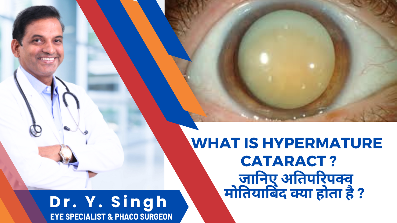 Hypermature cataracts