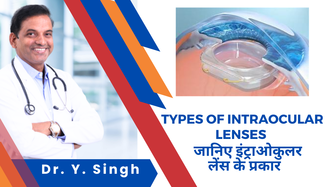 इंट्राओकुलर लेंस के प्रकार Types of Intraocular Lenses (IOLs)