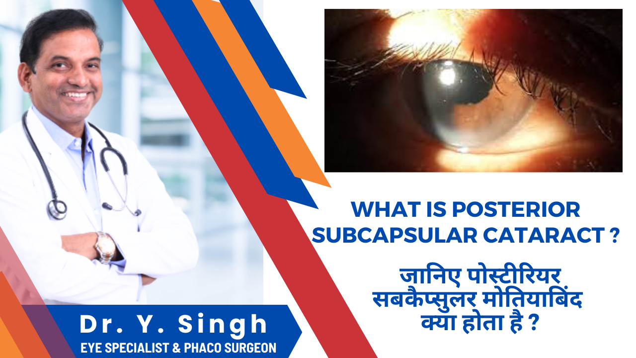 Posterior Subcapsular Cataract