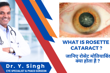 Rosette Cataract