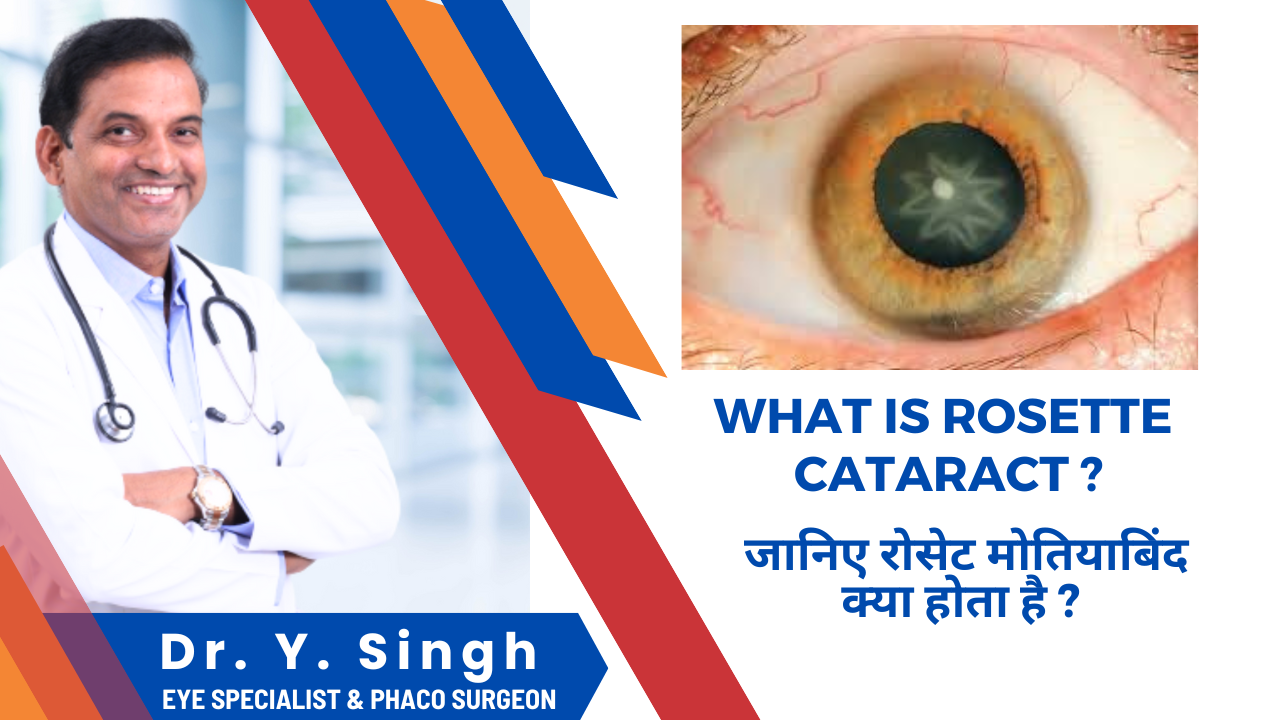 Rosette Cataract